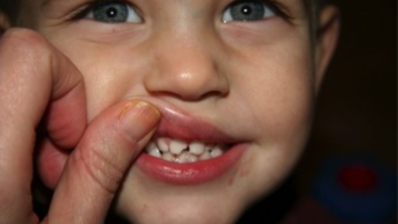 chipped baby tooth uk